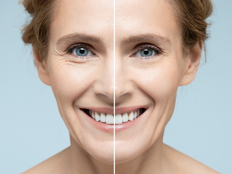 Das Gesicht einer Frau vor und nach Hautstraffungs- und Anti-Aging-Behandlungen. Entfernung von Falten, Nasolabialfalten, Hautverjüngungsbehandlung