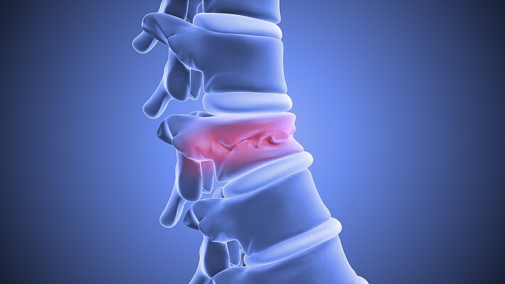 Spinalkanalstenose