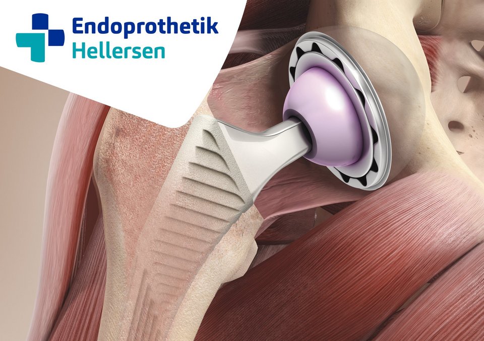 Endoprothetik_Zentrum_künstlichen_Gelenkersatz_Hüftprothese_Schulterprothese
